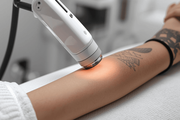 Laser Tattoo Removal service